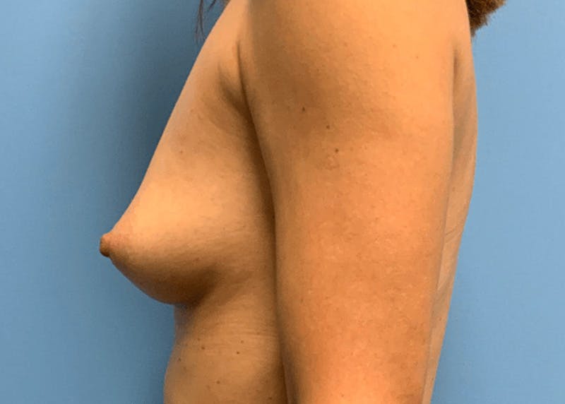 Breast Augmentation Before & After Gallery - Patient 55612930 - Image 3