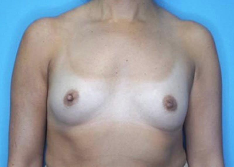 Breast Augmentation Before & After Gallery - Patient 77479284 - Image 1
