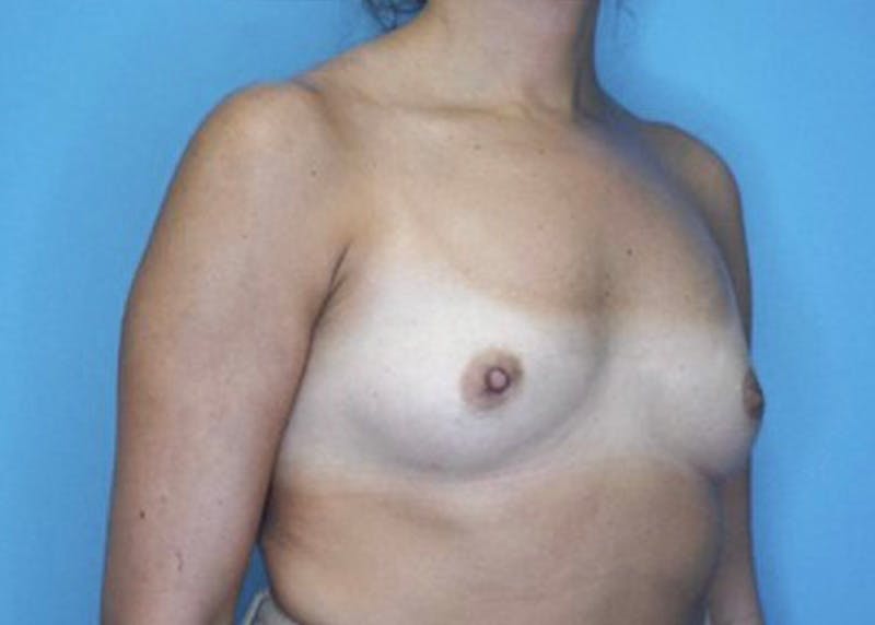Breast Augmentation Before & After Gallery - Patient 77479284 - Image 3