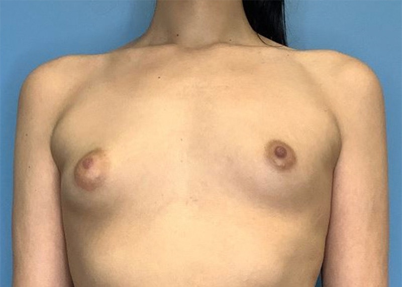 Breast Augmentation Before & After Gallery - Patient 77849550 - Image 1