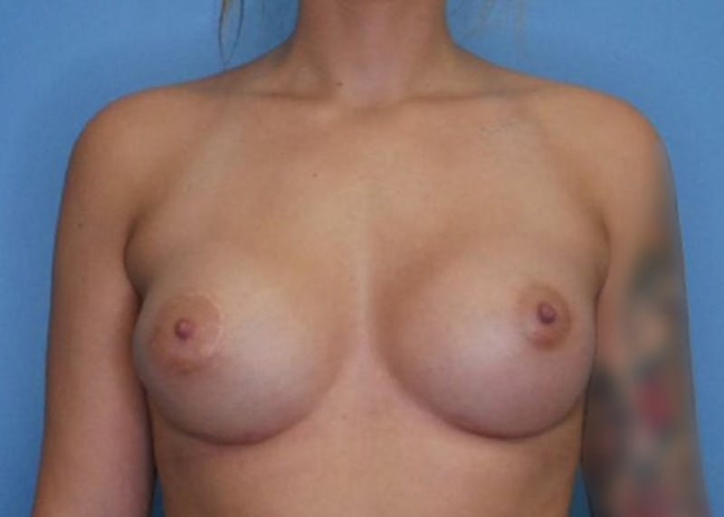 Breast Augmentation Before & After Gallery - Patient 77849550 - Image 2
