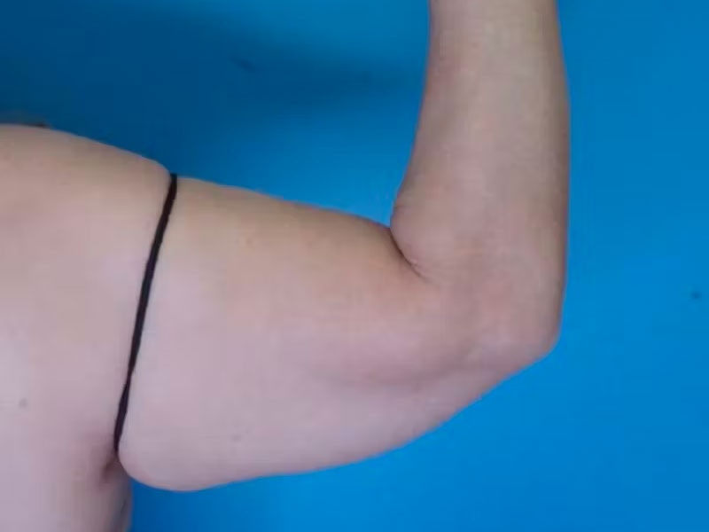 Arm Lift (Brachioplasty)  Before & After Gallery - Patient 83594388 - Image 1