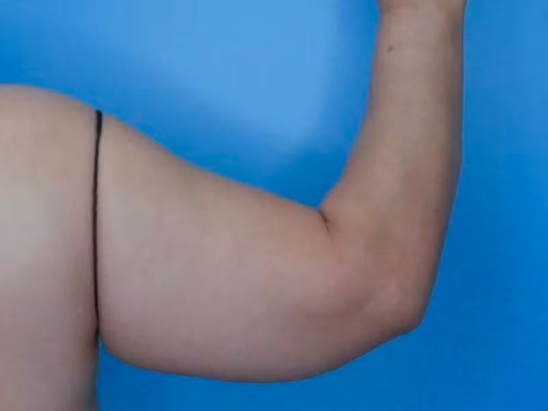 Arm Lift (Brachioplasty)  Before & After Gallery - Patient 83594388 - Image 2
