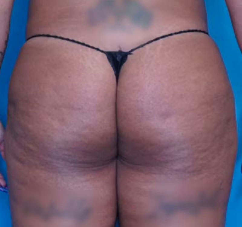 BBL (Brazilian Butt Lift) Before & After Gallery - Patient 86841502 - Image 1
