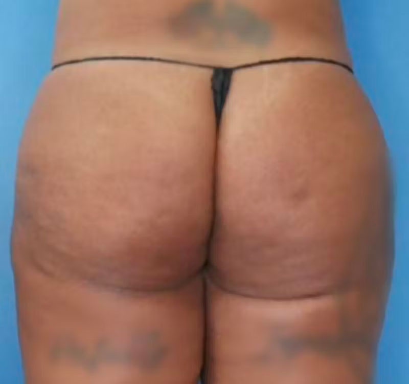 BBL (Brazilian Butt Lift) Before & After Gallery - Patient 86841502 - Image 2
