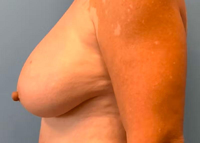 Breast Lift Before & After Gallery - Patient 55612931 - Image 1