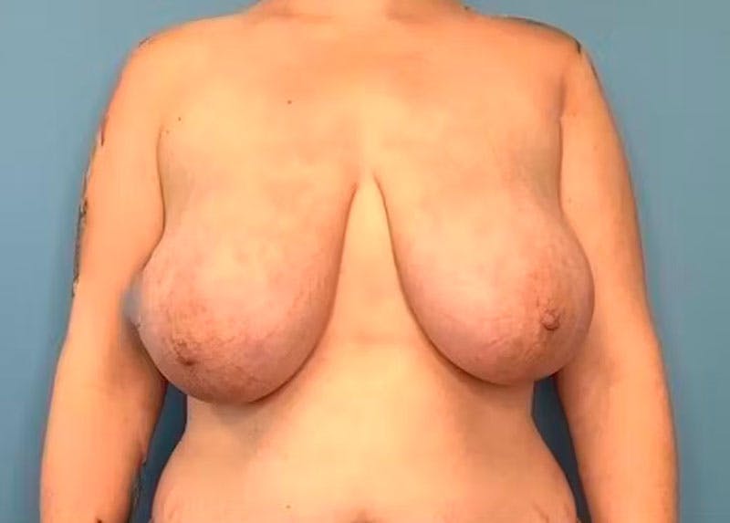 Breast Reduction Before & After Gallery - Patient 133227831 - Image 1