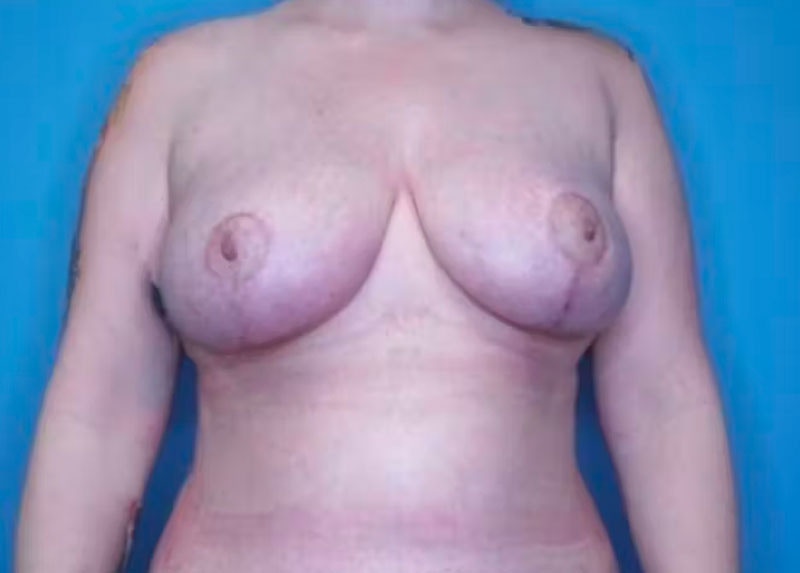Breast Reduction Before & After Gallery - Patient 133227831 - Image 2
