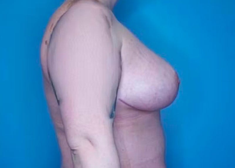 Breast Reduction Before & After Gallery - Patient 133227831 - Image 4