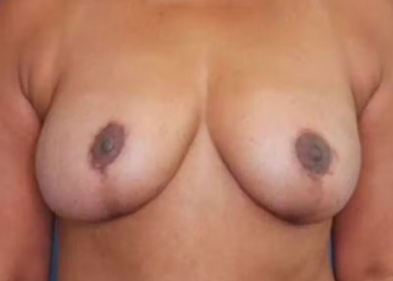 Breast Reduction Before & After Gallery - Patient 133227879 - Image 2