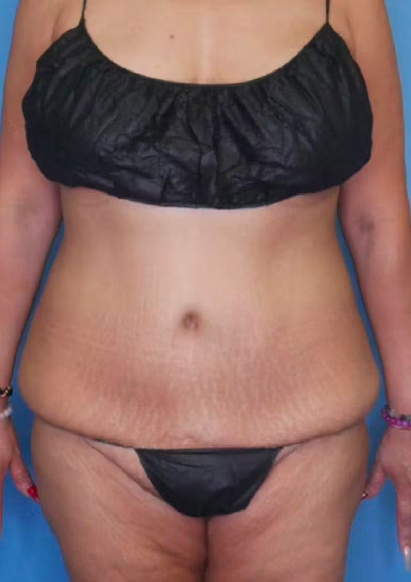 Mini Tummy Tuck Before & After Gallery - Patient 83594397 - Image 1