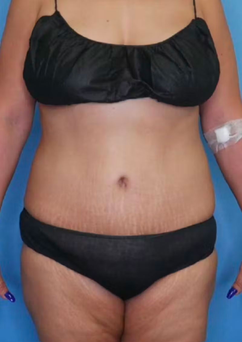Mini Tummy Tuck Before & After Gallery - Patient 83594397 - Image 2