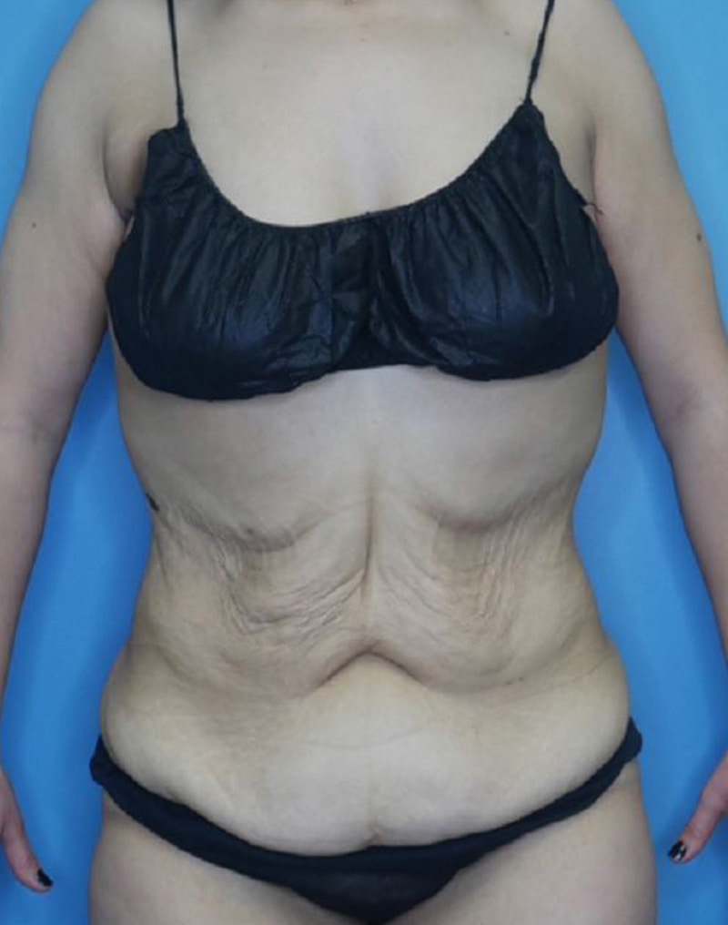 Tummy Tuck (Abdominoplasty)  Before & After Gallery - Patient 165603431 - Image 1