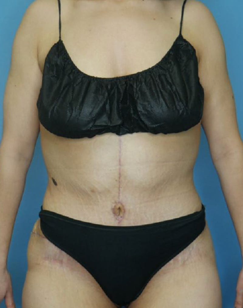 Tummy Tuck (Abdominoplasty)  Before & After Gallery - Patient 165603431 - Image 2