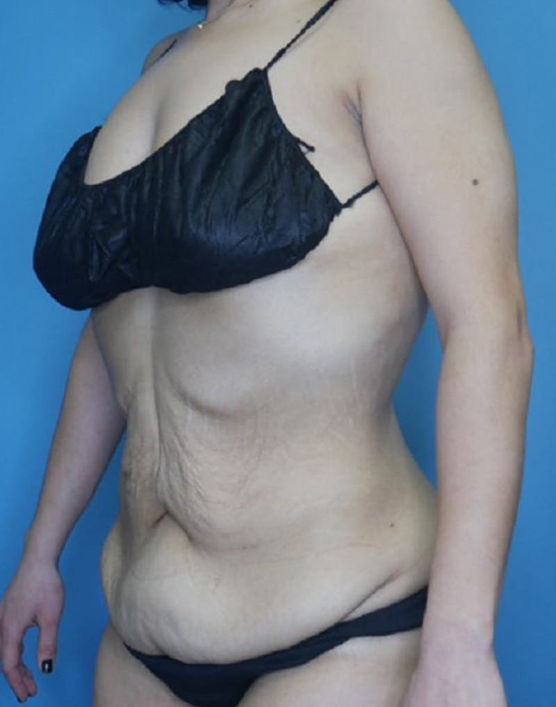 Tummy Tuck (Abdominoplasty)  Before & After Gallery - Patient 165603431 - Image 3