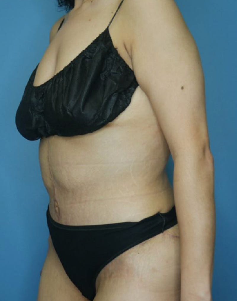 Tummy Tuck (Abdominoplasty)  Before & After Gallery - Patient 165603431 - Image 4