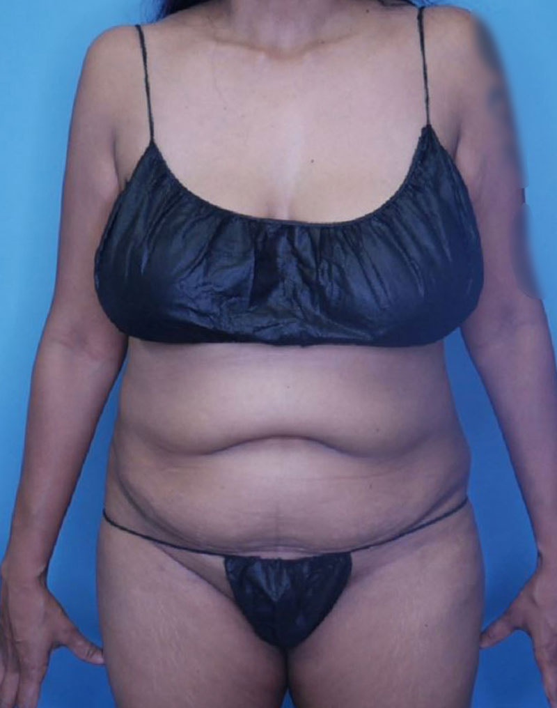 Tummy Tuck (Abdominoplasty)  Before & After Gallery - Patient 166959163 - Image 1