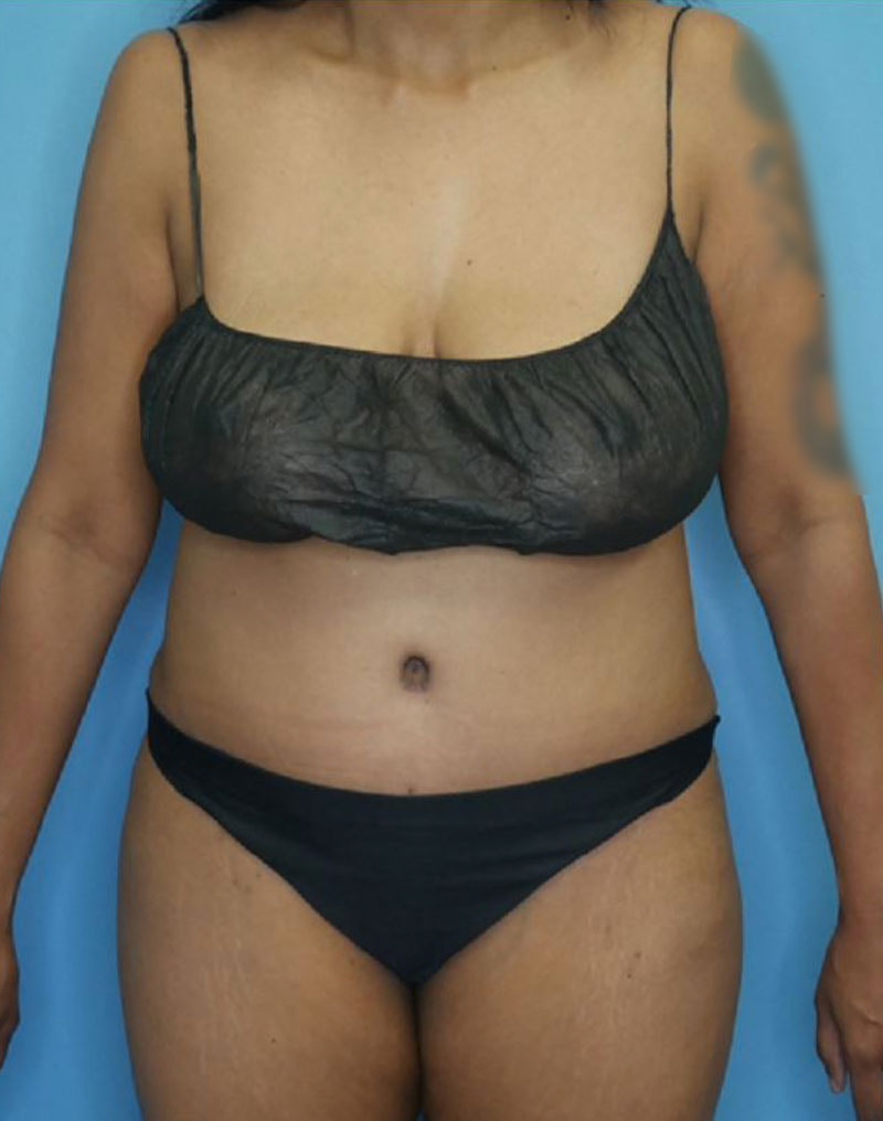 Tummy Tuck (Abdominoplasty)  Before & After Gallery - Patient 166959163 - Image 2