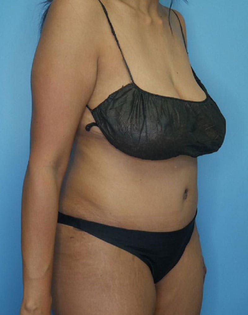 Tummy Tuck (Abdominoplasty)  Before & After Gallery - Patient 166959163 - Image 4