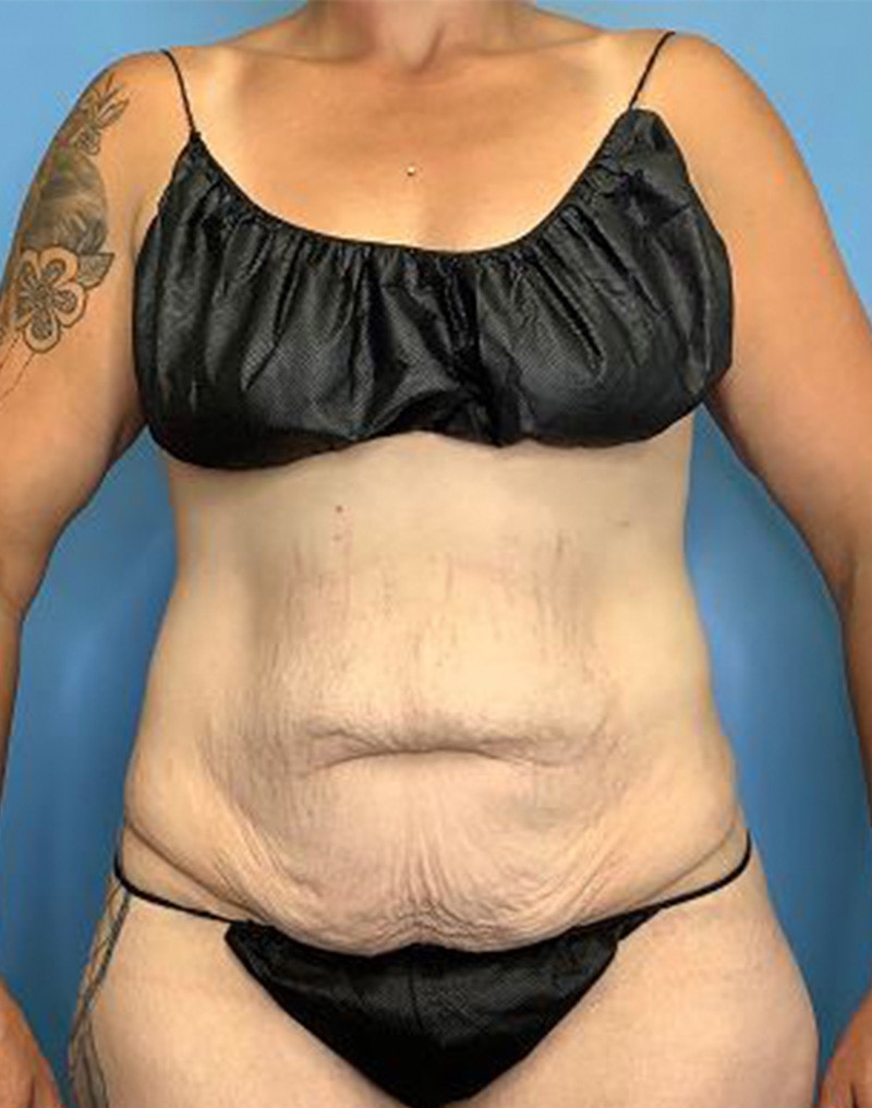 Tummy Tuck (Abdominoplasty)  Before & After Gallery - Patient 55612924 - Image 1