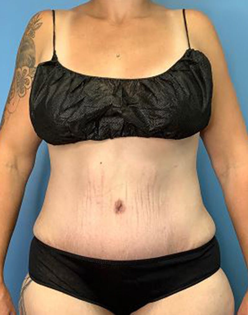 Tummy Tuck (Abdominoplasty)  Before & After Gallery - Patient 55612924 - Image 2