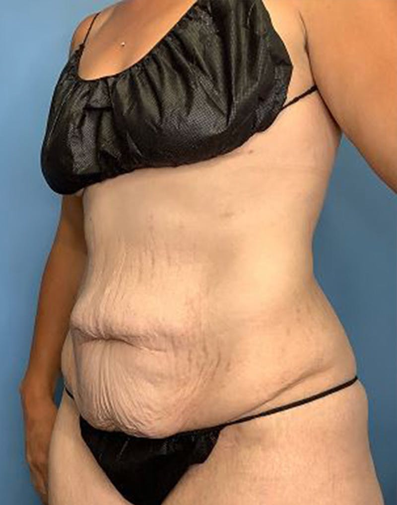 Tummy Tuck (Abdominoplasty)  Before & After Gallery - Patient 55612924 - Image 5