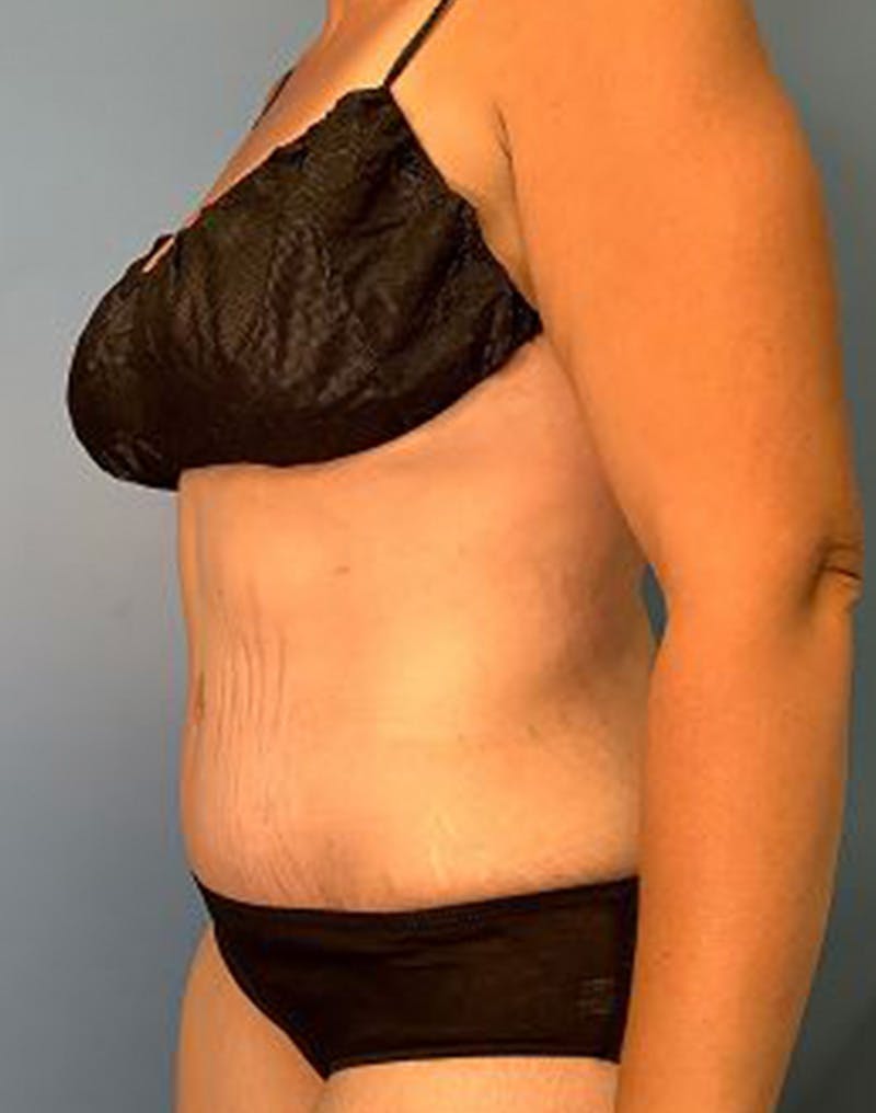 Tummy Tuck (Abdominoplasty)  Before & After Gallery - Patient 55612924 - Image 6