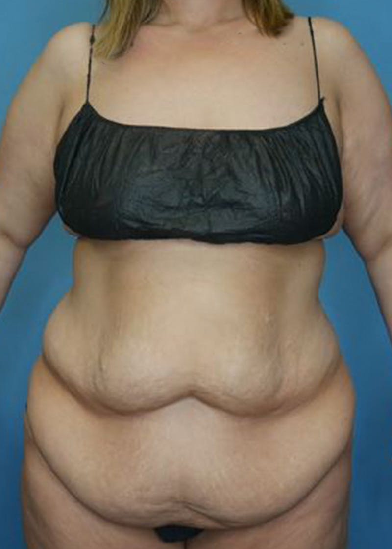 Tummy Tuck (Abdominoplasty)  Before & After Gallery - Patient 168932109 - Image 1