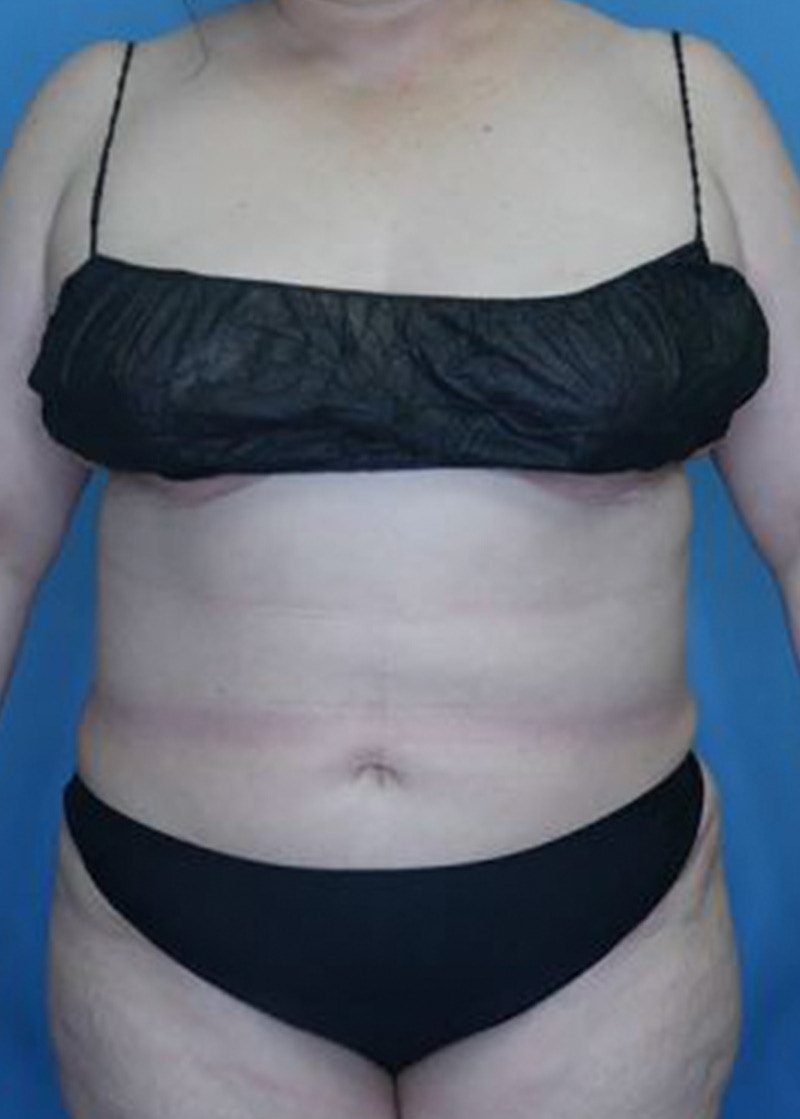 Tummy Tuck (Abdominoplasty)  Before & After Gallery - Patient 168932109 - Image 2