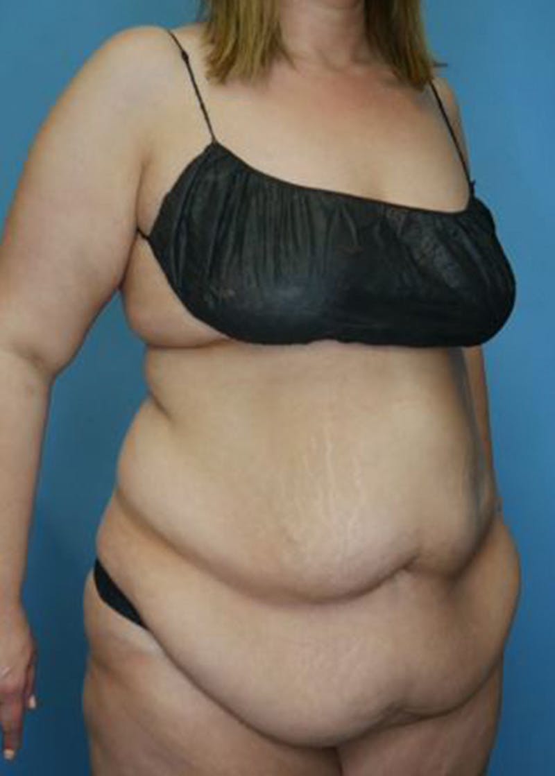 Tummy Tuck (Abdominoplasty)  Before & After Gallery - Patient 168932109 - Image 3