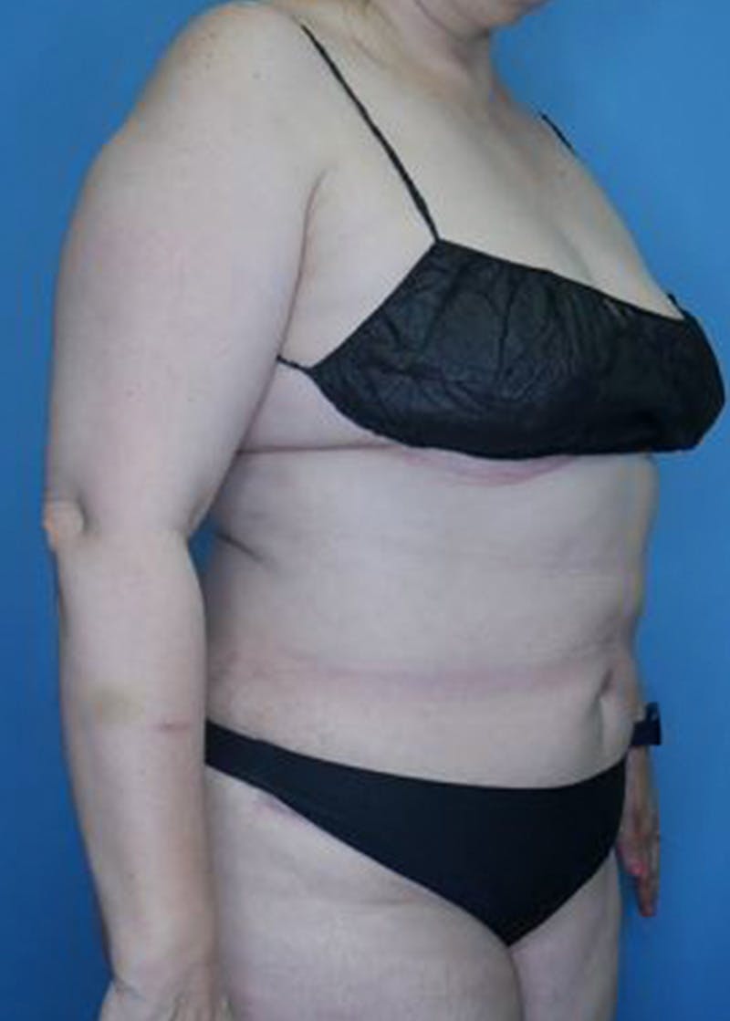 Tummy Tuck (Abdominoplasty)  Before & After Gallery - Patient 168932109 - Image 4