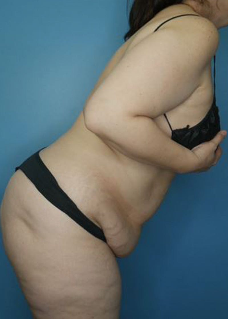 Tummy Tuck (Abdominoplasty)  Before & After Gallery - Patient 168932109 - Image 5