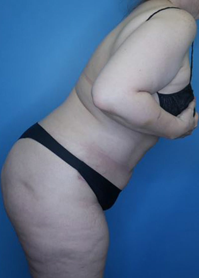 Tummy Tuck (Abdominoplasty)  Before & After Gallery - Patient 168932109 - Image 6