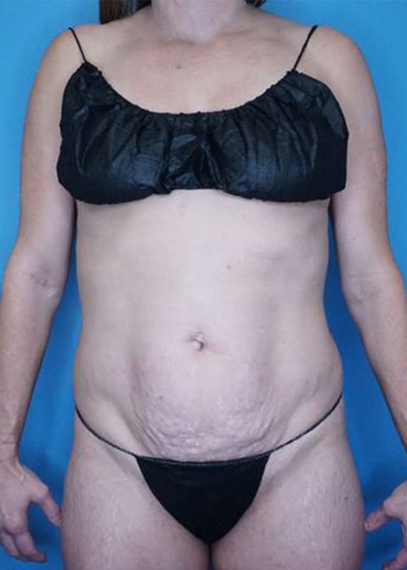 Mini Tummy Tuck Before & After Gallery - Patient 168909865 - Image 1