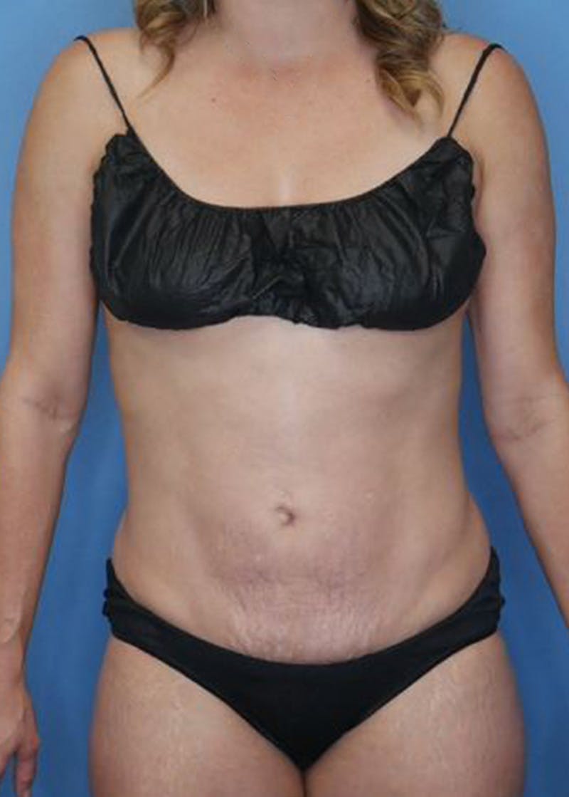 Mini Tummy Tuck Before & After Gallery - Patient 168909865 - Image 2