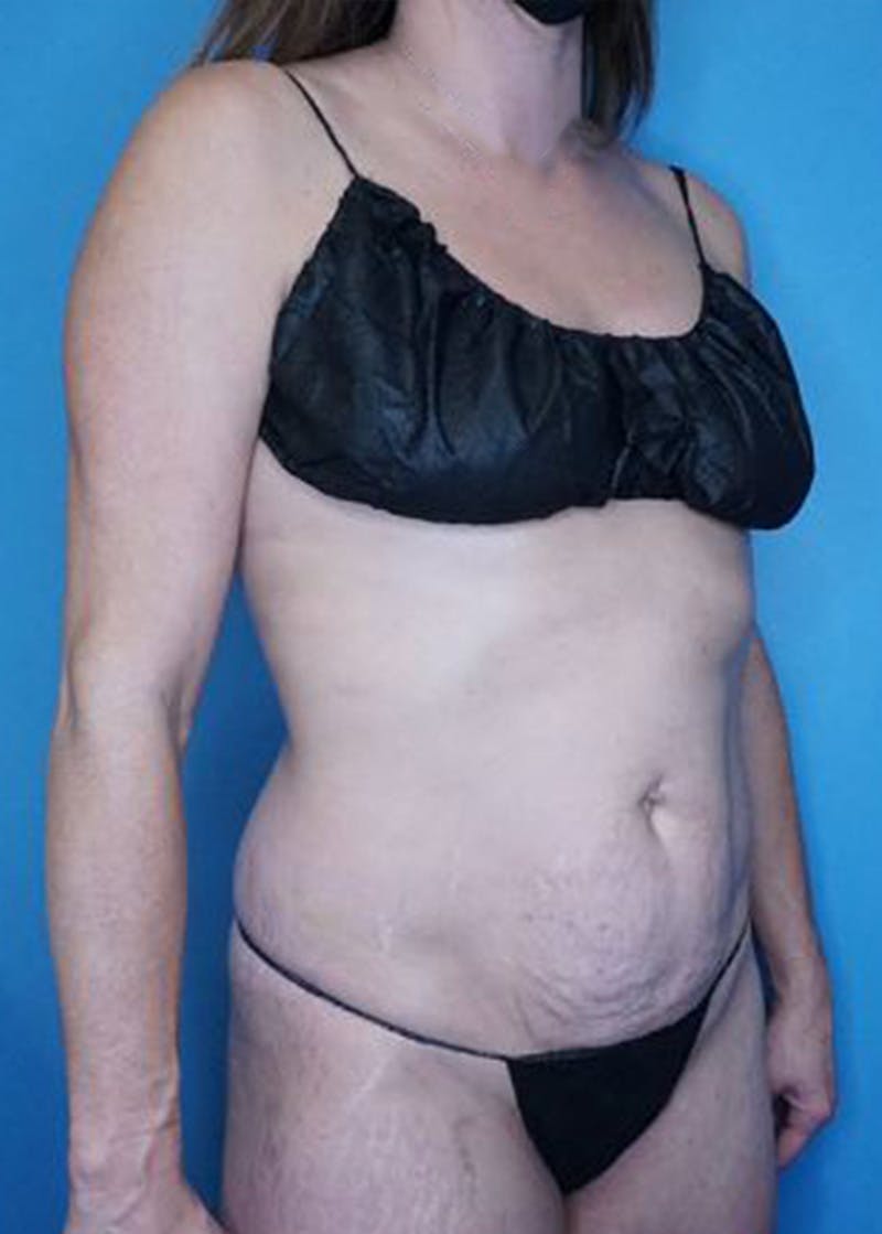 Mini Tummy Tuck Before & After Gallery - Patient 168909865 - Image 3