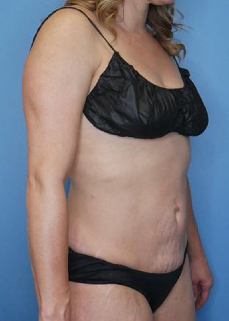 Vaser Liposuction Before & After Gallery - Patient 168909866 - Image 4