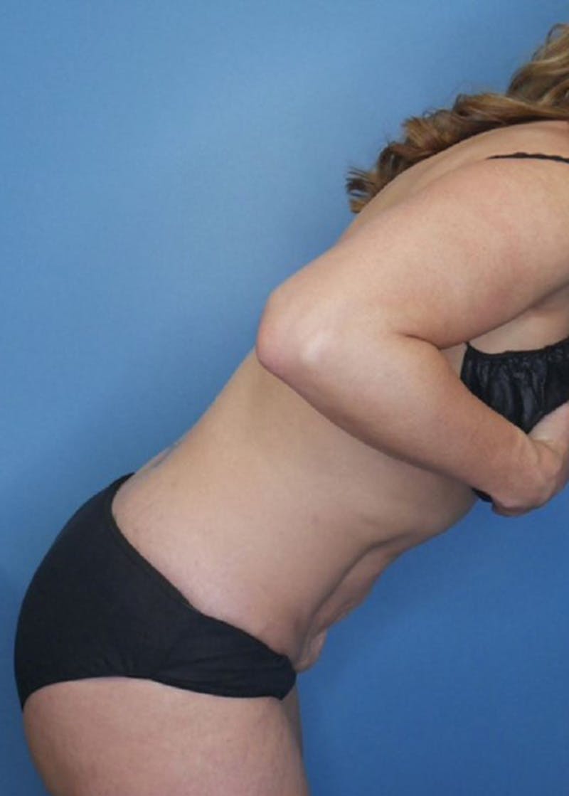 Mini Tummy Tuck Before & After Gallery - Patient 168909865 - Image 6