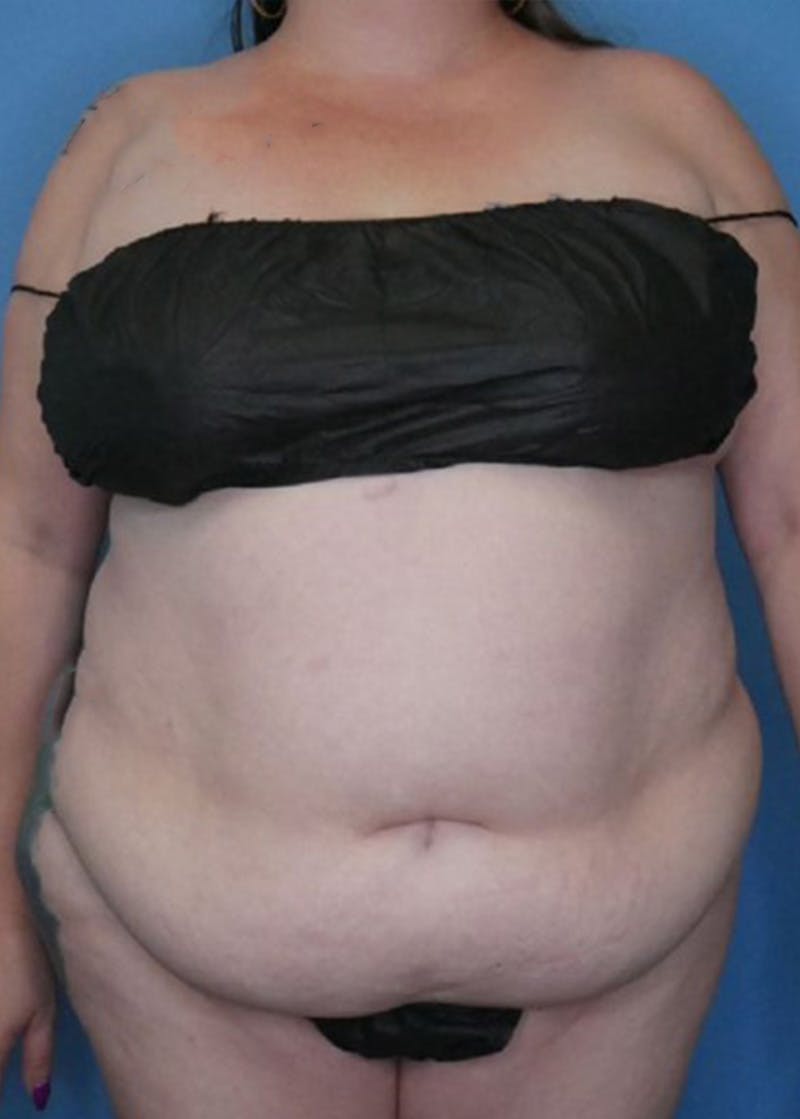 Vaser Liposuction Before & After Gallery - Patient 168909922 - Image 1