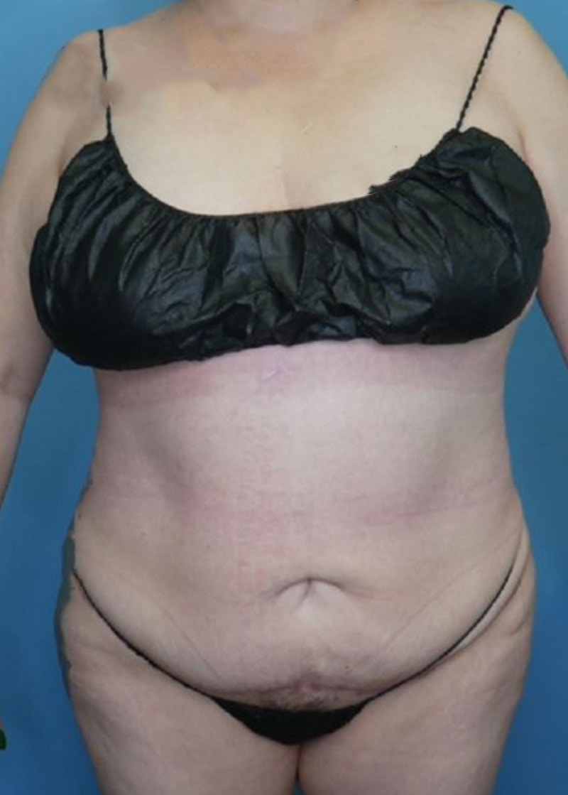 Vaser Liposuction Before & After Gallery - Patient 168909922 - Image 2