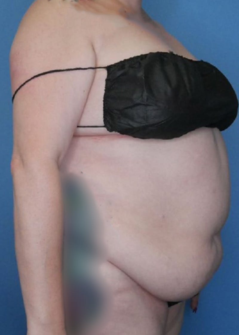 Vaser Liposuction Before & After Gallery - Patient 168909922 - Image 3
