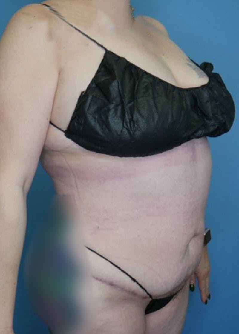 Vaser Liposuction Before & After Gallery - Patient 168909922 - Image 4
