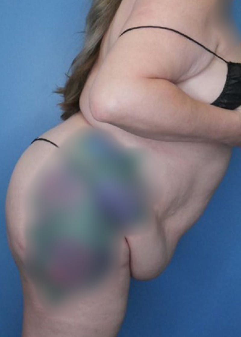 Vaser Liposuction Before & After Gallery - Patient 168909922 - Image 5