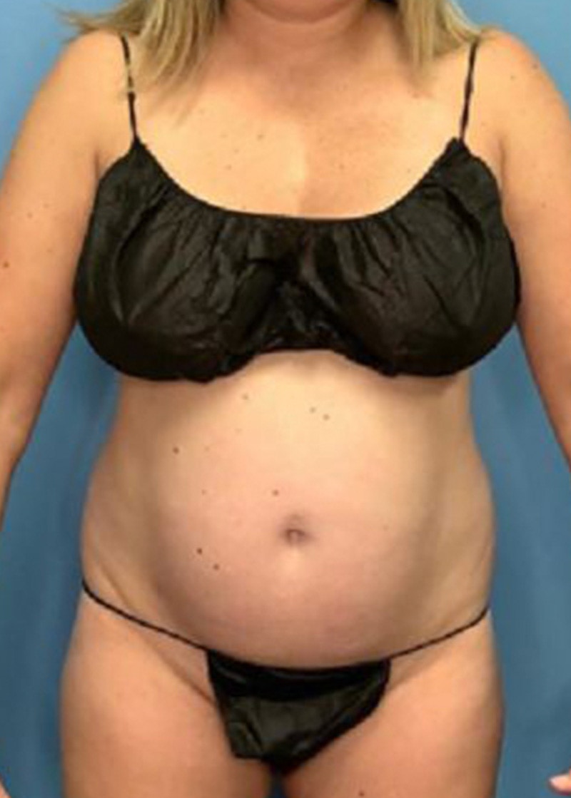 Tummy Tuck (Abdominoplasty)  Before & After Gallery - Patient 168909928 - Image 1