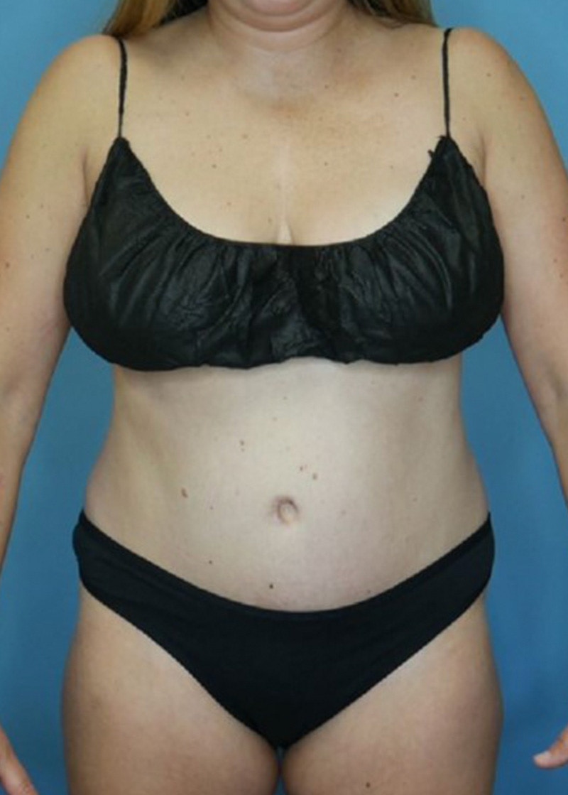 Tummy Tuck (Abdominoplasty)  Before & After Gallery - Patient 168909928 - Image 2