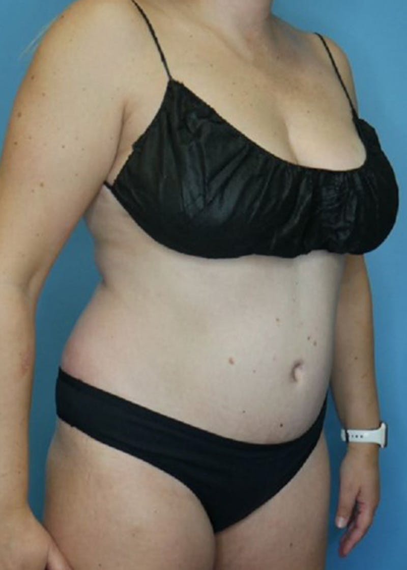 Tummy Tuck (Abdominoplasty)  Before & After Gallery - Patient 168909928 - Image 4