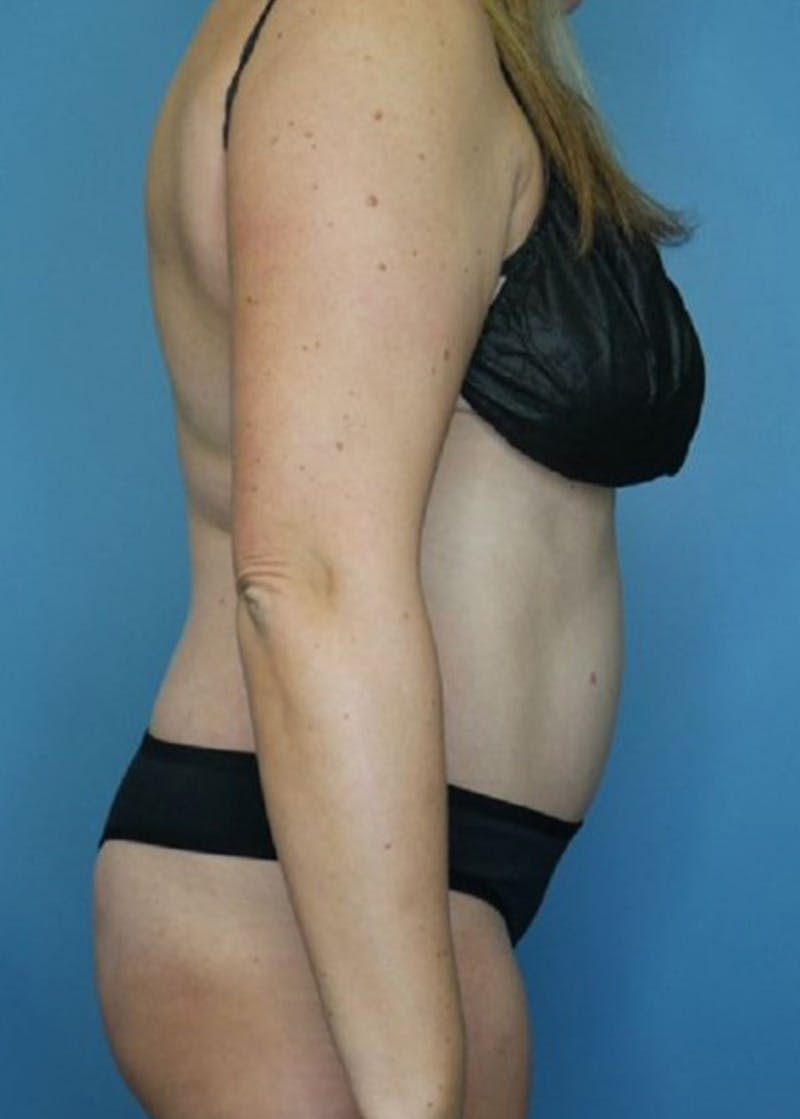 Tummy Tuck (Abdominoplasty)  Before & After Gallery - Patient 168909928 - Image 6