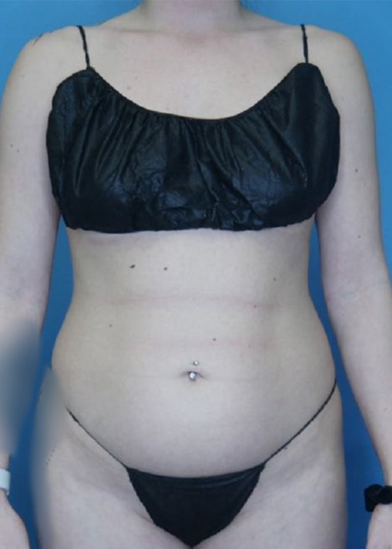 Vaser Liposuction Before & After Gallery - Patient 168926812 - Image 1