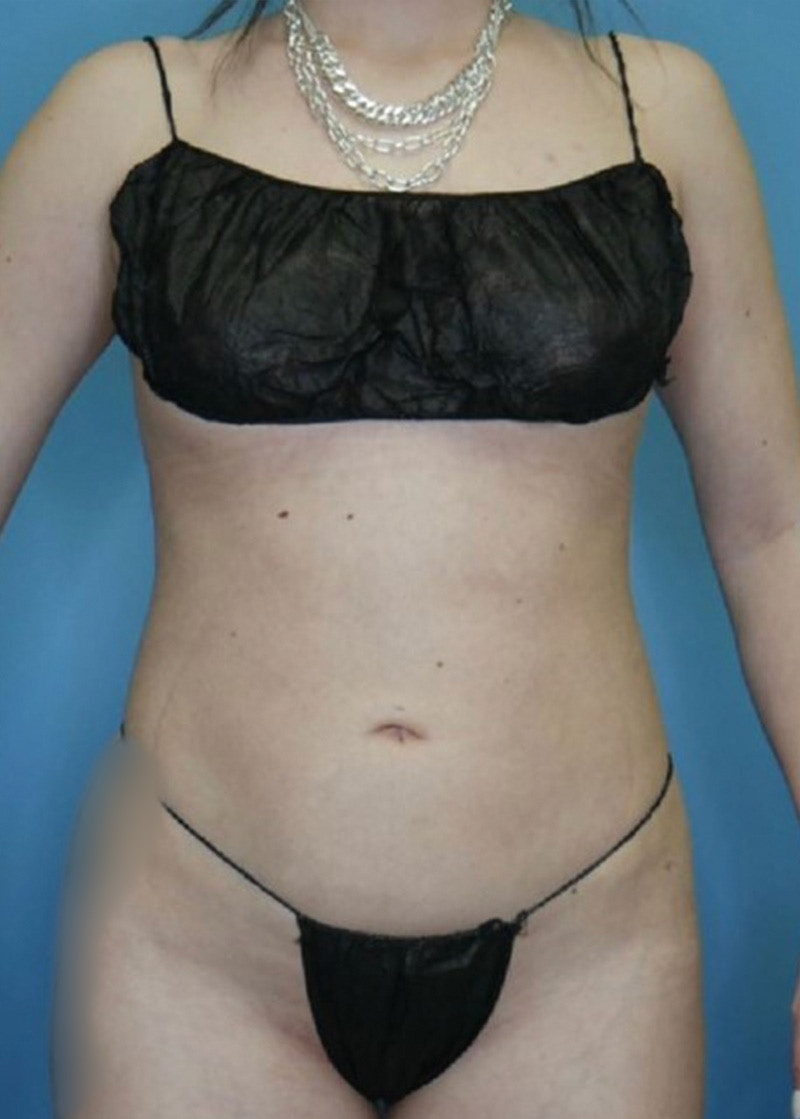 Vaser Liposuction Before & After Gallery - Patient 168926812 - Image 2