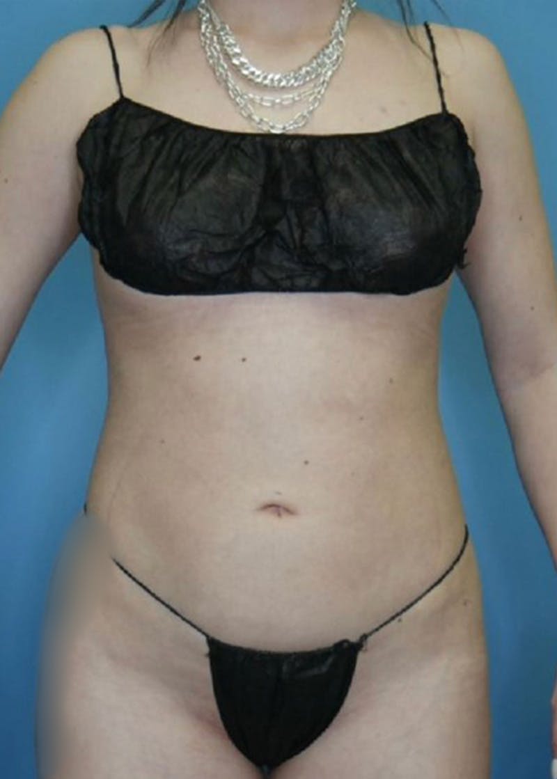 Vaser Liposuction Before & After Gallery - Patient 168926812 - Image 2